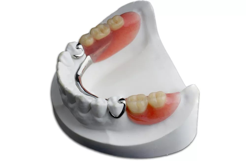 Протезирование зубов - бюгельный протез