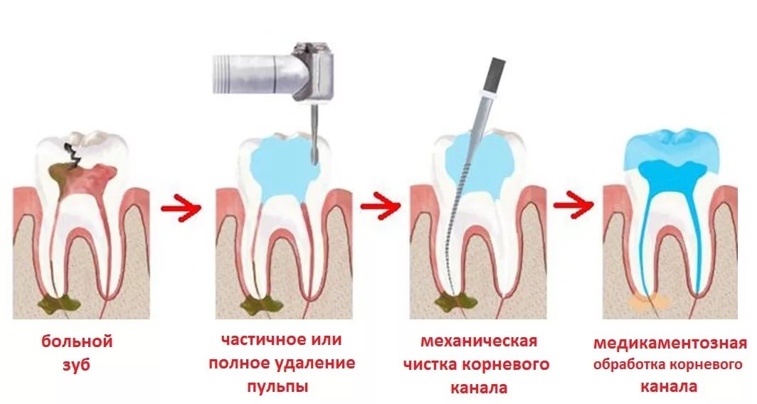Лечение зубов - лечение каналов зуба