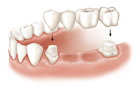 Протезирование зубов - мостовидный протез