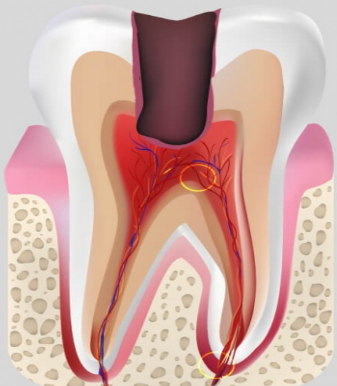 Лечение зубов - лечение пульпита