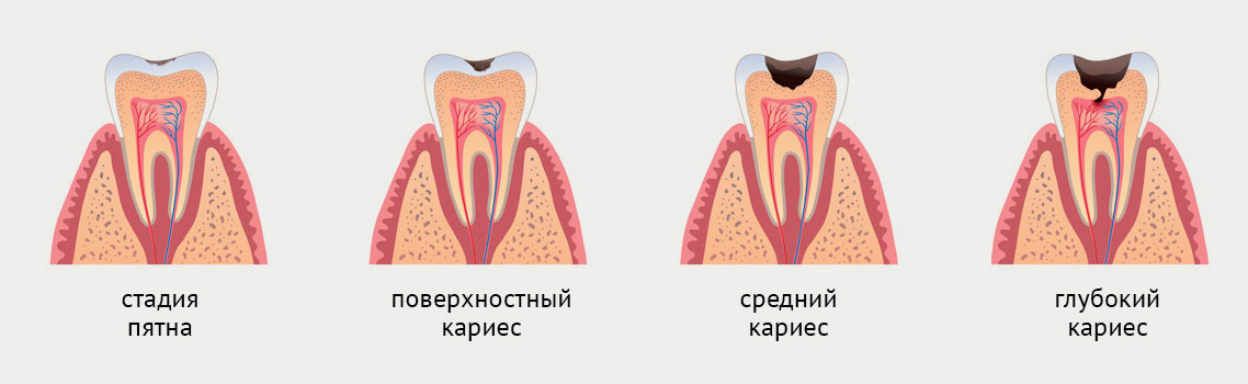 Лечение зубов - стадии кариеса